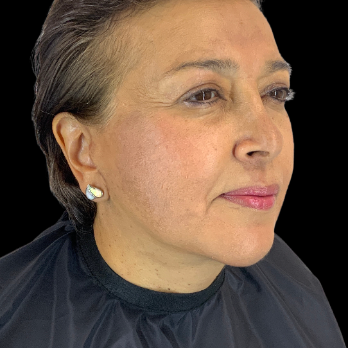 after-deep-plane-facelift-necklift-chin-implant